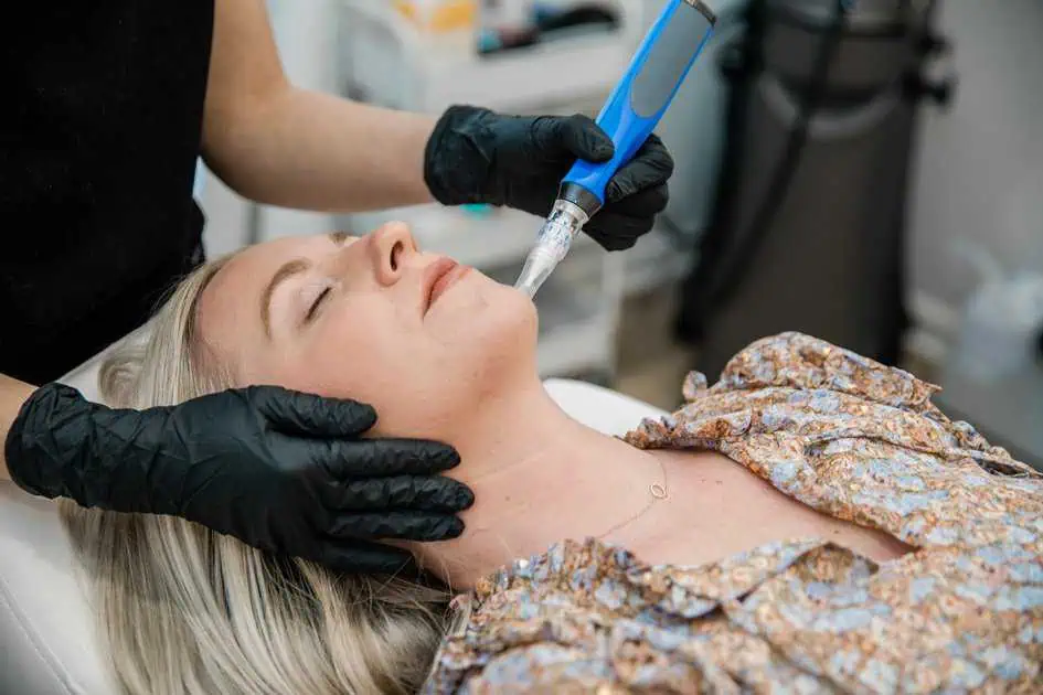 Microneedling Treatment by Fresh Face Aesthetics in Meridian ID